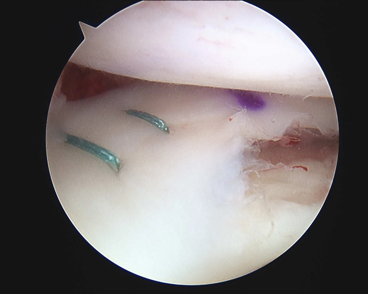 Intra-operative arthroscopic image of meniscal transplantation