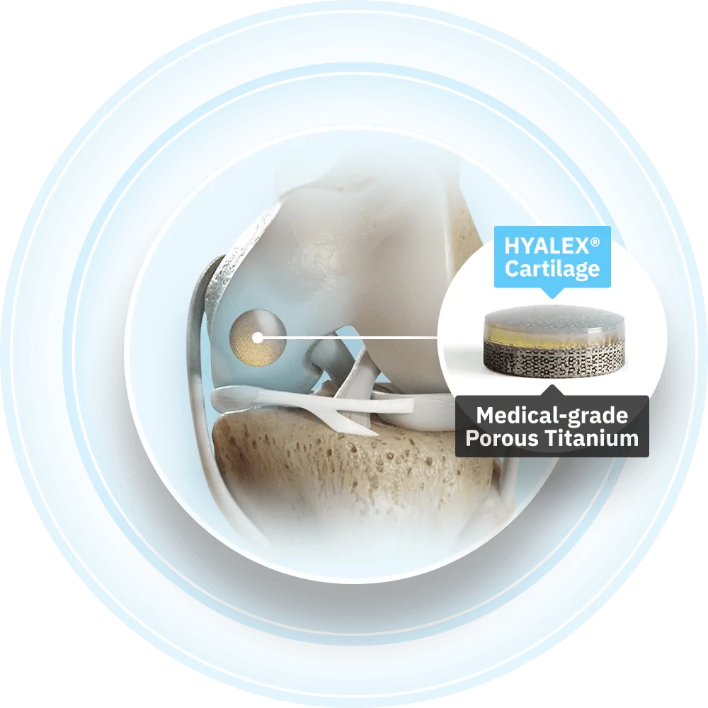 Diagram of the HYALEX Knee Cartilage System implant