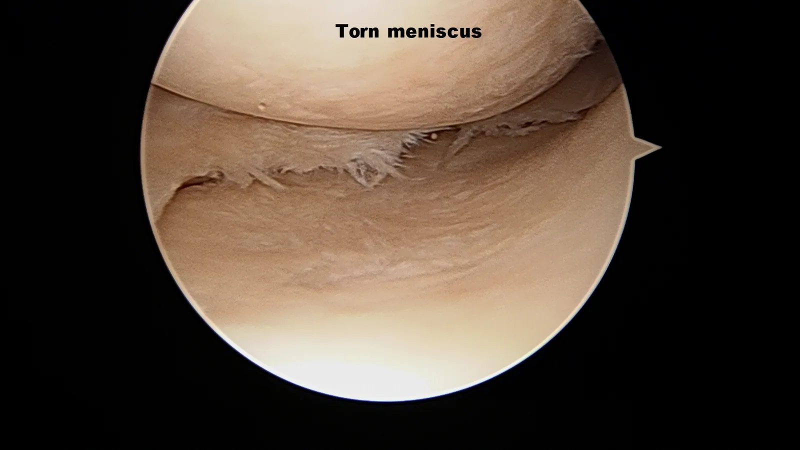 Intra-operative arthroscopic image of meniscectomy