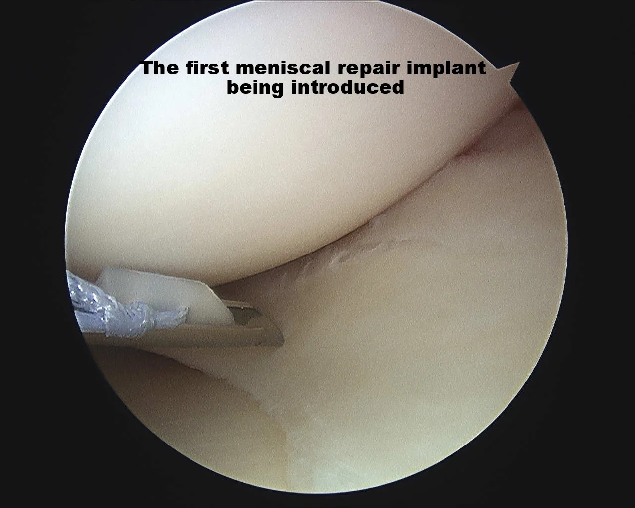 Intra-operative arthroscopic image of meniscal repair
