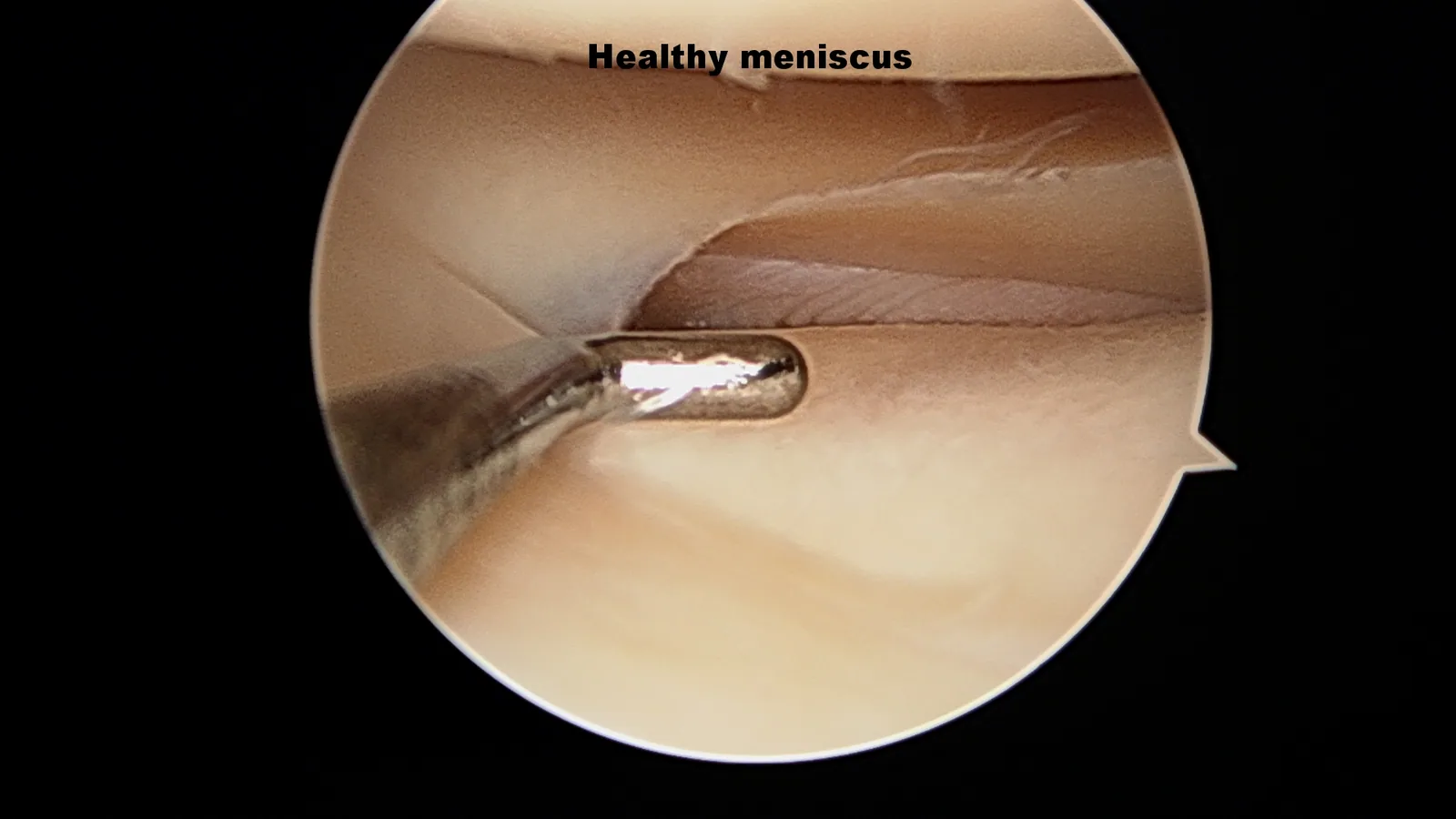 Intra-operative arthroscopic image of meniscectomy