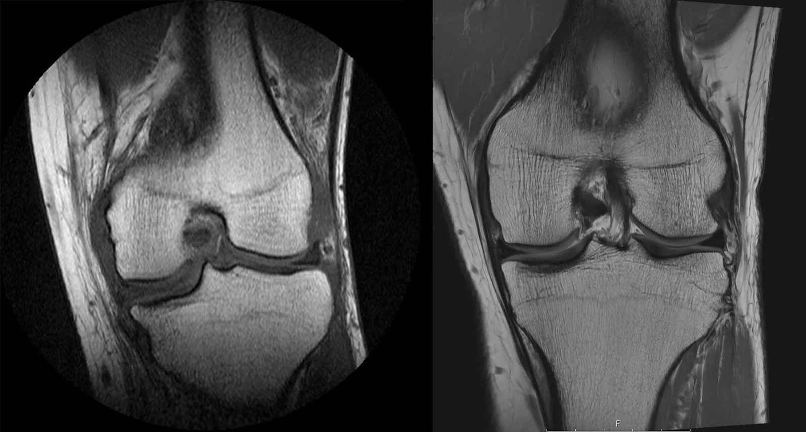 Coronal MRI comparison: outside image (left) versus HSS MRI (right) showing higher resolution