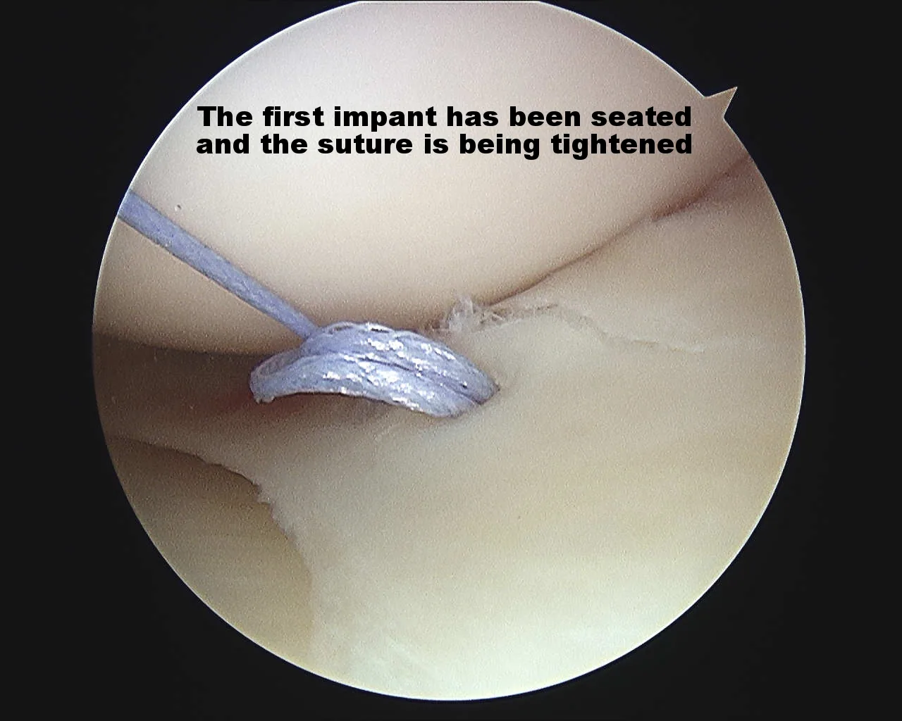 Intra-operative arthroscopic image of meniscal repair