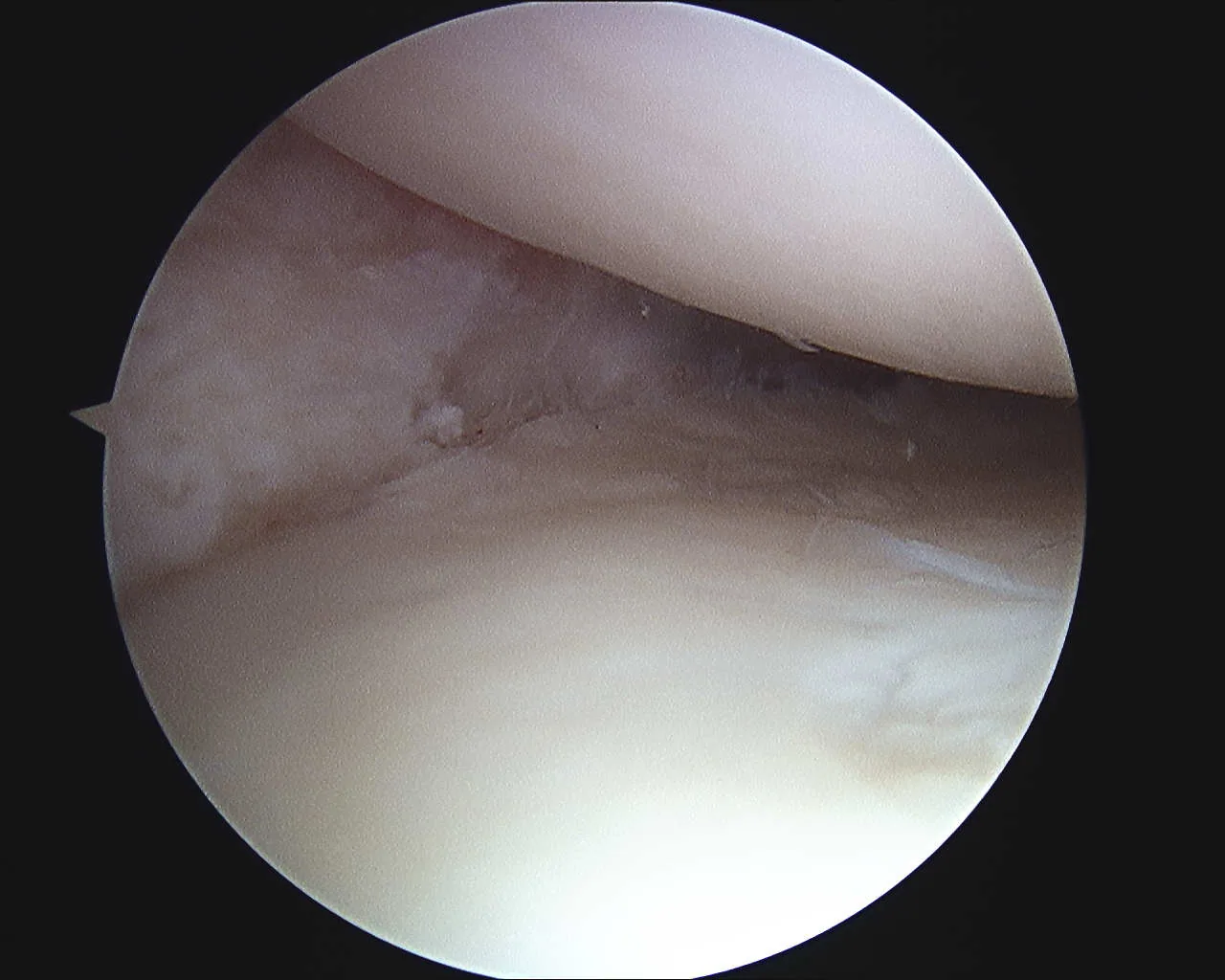 Intra-operative arthroscopic image of meniscal transplantation