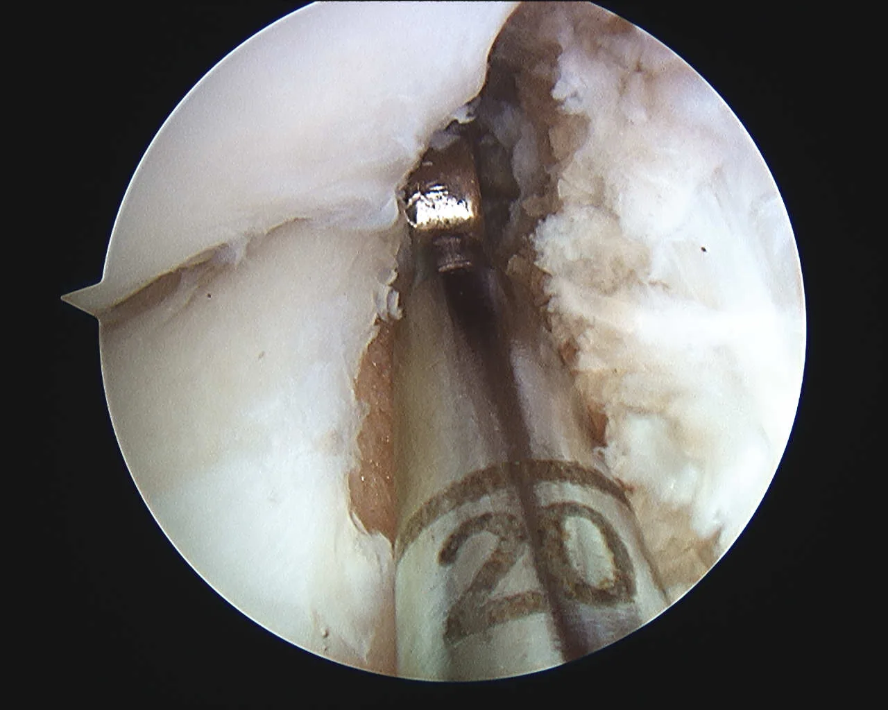 Intra-operative arthroscopic image of meniscal transplantation