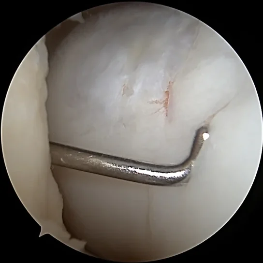 Second-look arthroscopy one year after Cartiheal implantation showing healed cartilage tissue
