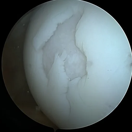 Arthroscopic view of a full-thickness cartilage defect in the trochlea before Cartiheal implantation