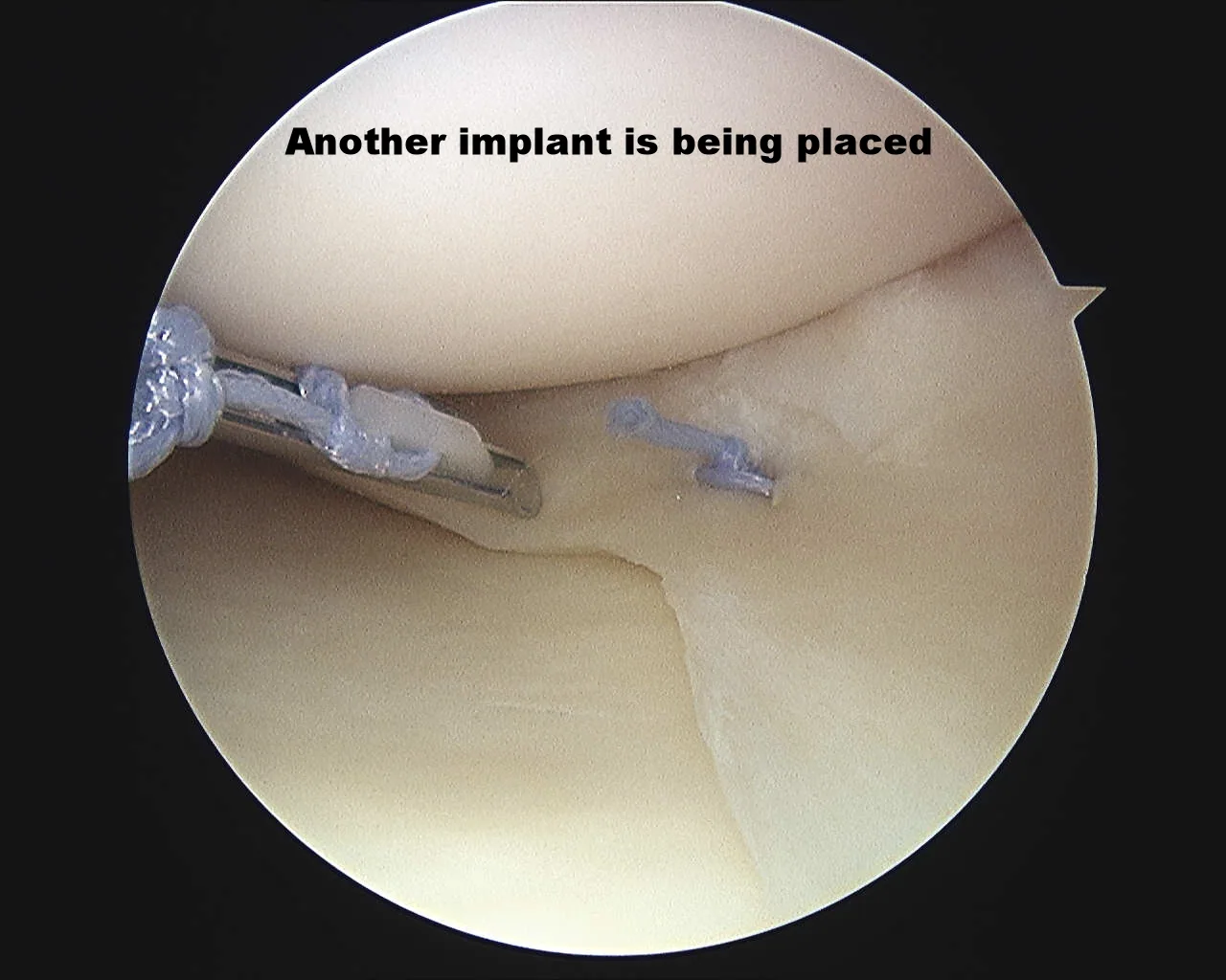 Intra-operative arthroscopic image of meniscal repair