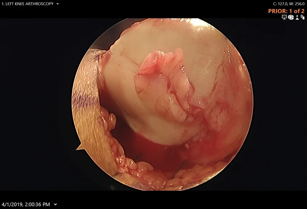 Arthroscopic view of large cartilage flaps in the patella before DeNovo cartilage repair