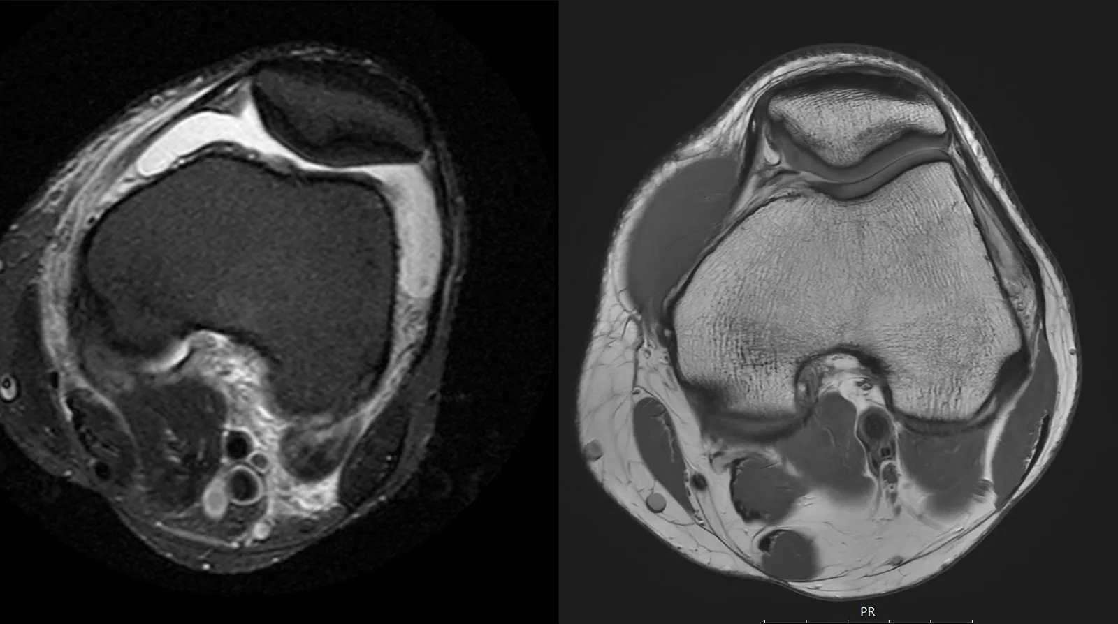 Axial MRI comparison: outside image (left) versus HSS MRI (right) showing higher resolution