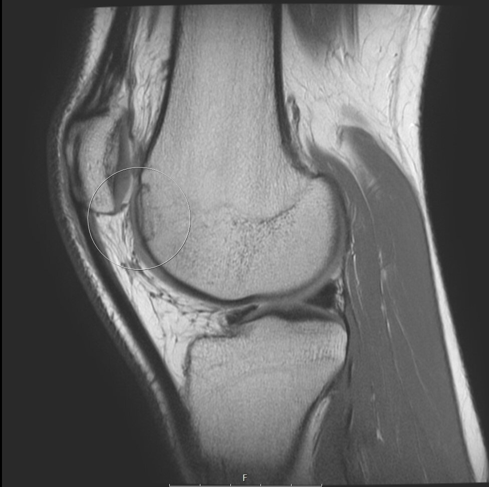 MRI image of the same knee six months after treatment with osteochondral allograft transplantation. The transplant is almost completely integrated into the native bone.